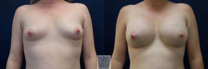 Before & After Breast Augmentation Case 729 Front View in Los Angeles & Torrance, CA, CA