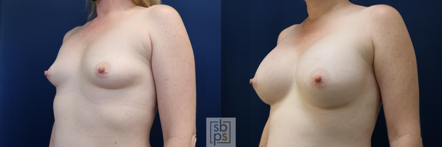 Before & After Breast Augmentation Case 729 Left Oblique View in Torrance & Los Angeles, CA, CA