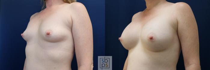 Before & After Breast Augmentation Case 729 Left Oblique View in Los Angeles & Torrance, CA, CA