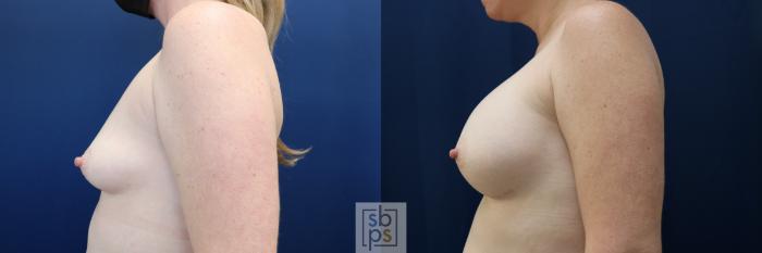 Before & After Breast Augmentation Case 729 Left Side View in Los Angeles & Torrance, CA, CA