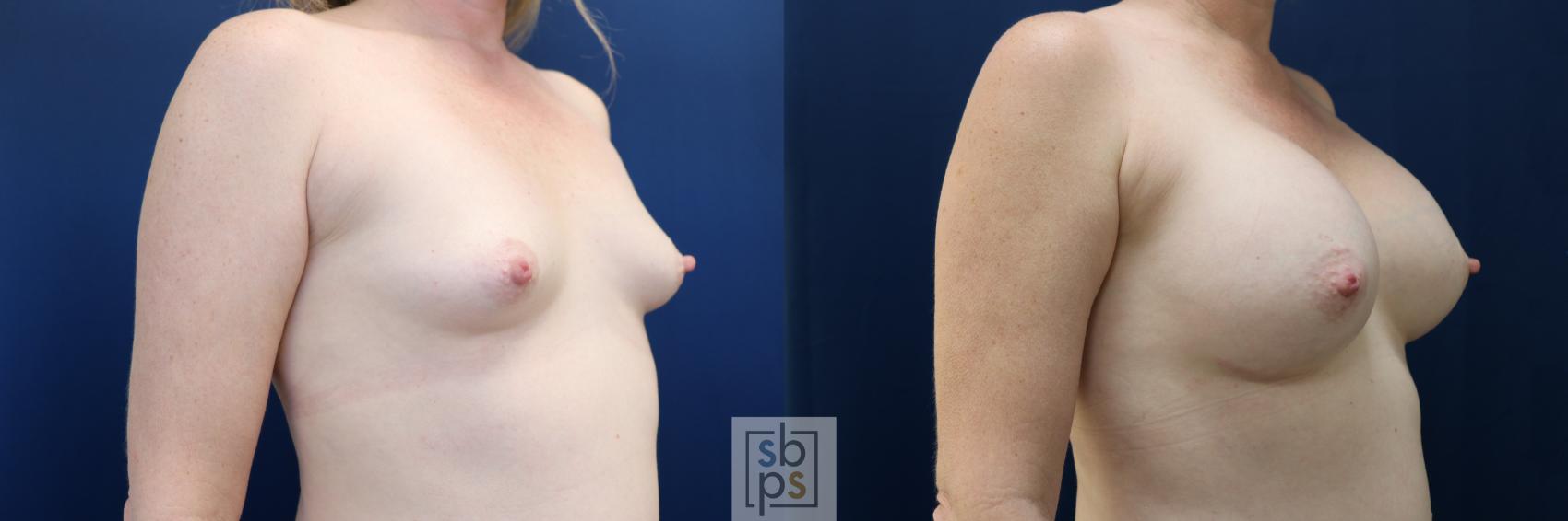 Before & After Breast Augmentation Case 729 Right Oblique View in Torrance & Los Angeles, CA, CA