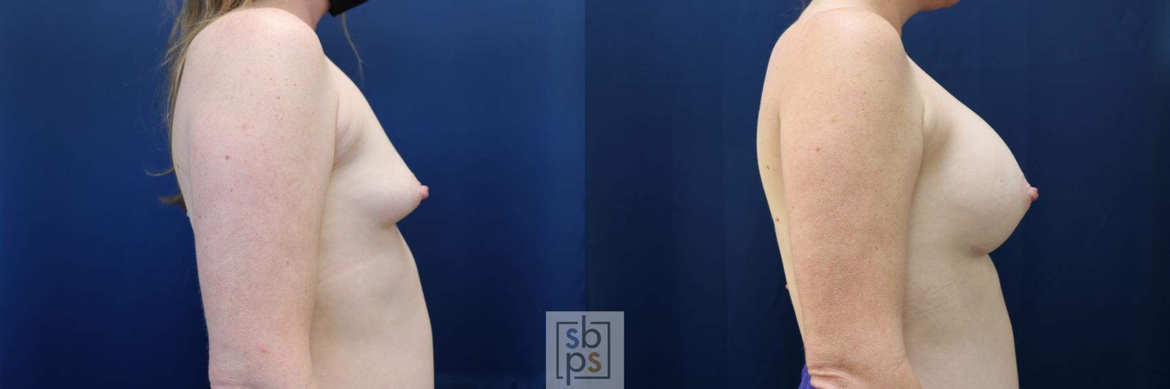 Before & After Breast Augmentation Case 729 Right Side View in Torrance & Los Angeles, CA, CA