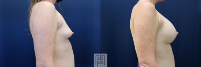 Before & After Breast Augmentation Case 729 Right Side View in Los Angeles & Torrance, CA, CA