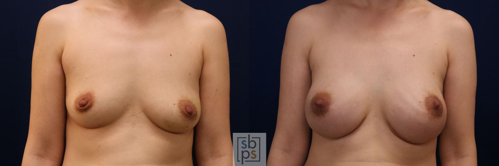 Before & After Breast Augmentation Case 774 Front View in Los Angeles, Torrance & Long Beach, CA