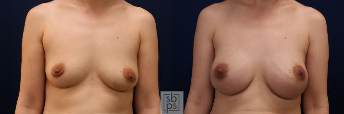 Before & After Breast Augmentation Case 774 Front View in Los Angeles, Torrance & Long Beach, CA