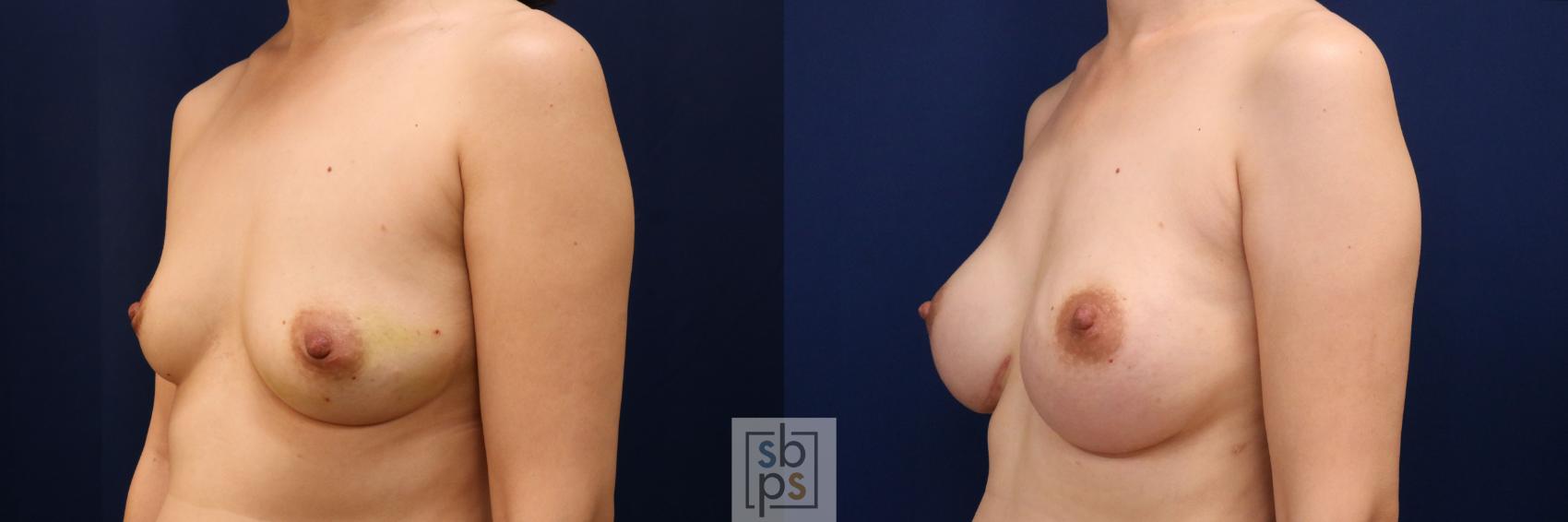 Before & After Breast Augmentation Case 774 Left Oblique View in Los Angeles, Torrance & Long Beach, CA