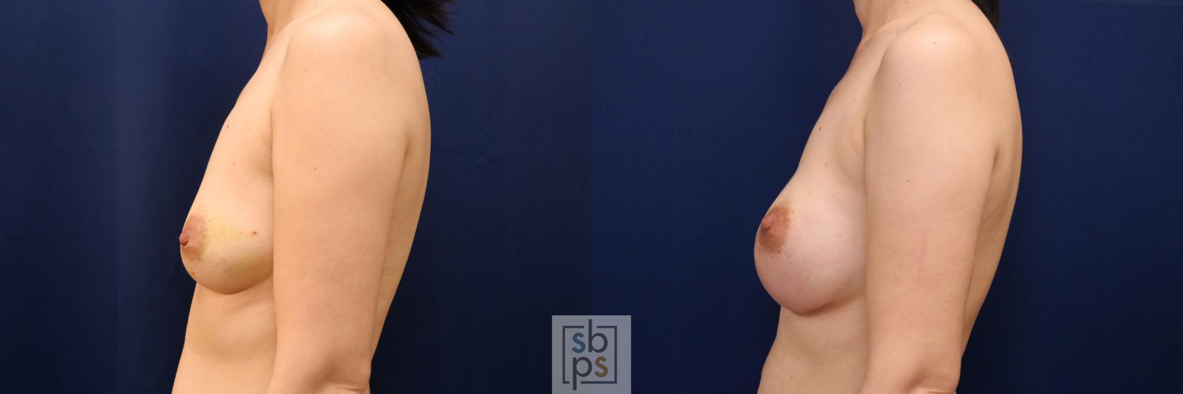 Before & After Breast Augmentation Case 774 Left Side View in Los Angeles, Torrance & Long Beach, CA