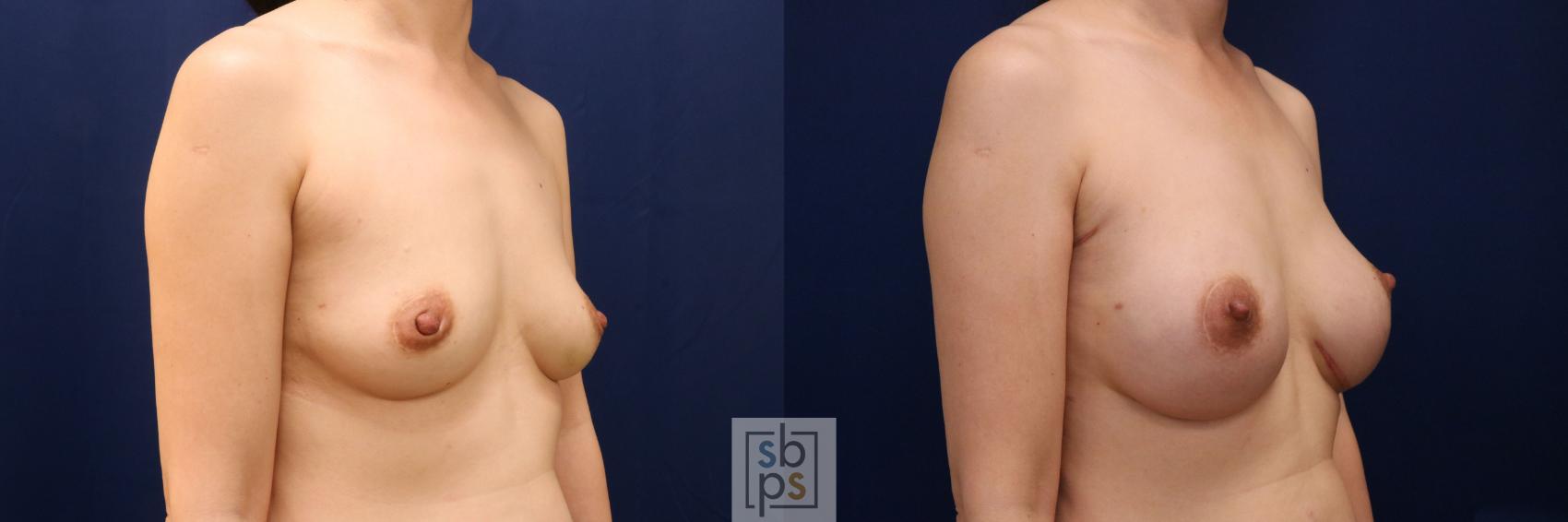 Before & After Breast Augmentation Case 774 Right Oblique View in Los Angeles, Torrance & Long Beach, CA