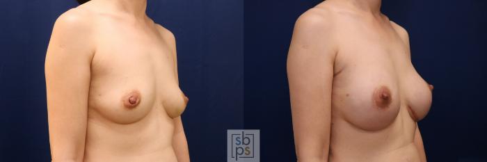 Before & After Breast Augmentation Case 774 Right Oblique View in Los Angeles, Torrance & Long Beach, CA