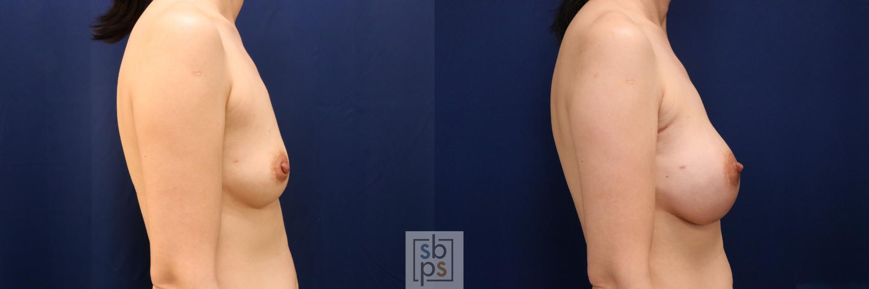 Before & After Breast Augmentation Case 774 Right Side View in Los Angeles, Torrance & Long Beach, CA
