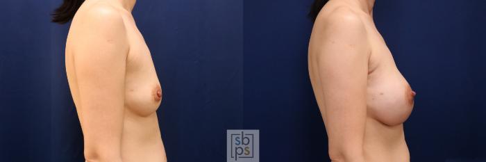 Before & After Breast Augmentation Case 774 Right Side View in Los Angeles, Torrance & Long Beach, CA