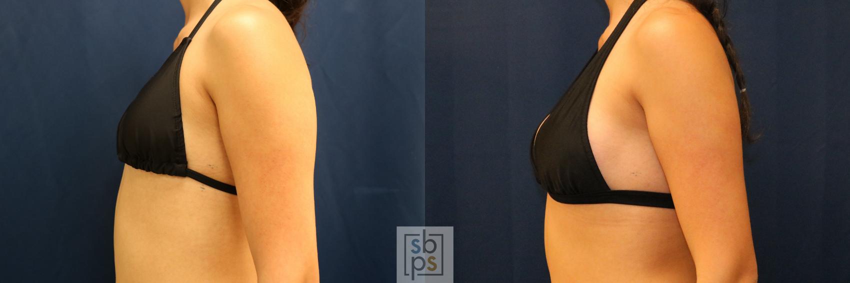 Before & After Breast Augmentation Case 775 Bikini Left View in Los Angeles, Torrance & Long Beach, CA