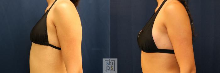 Before & After Breast Augmentation Case 775 Bikini Left View in Los Angeles, Torrance & Long Beach, CA
