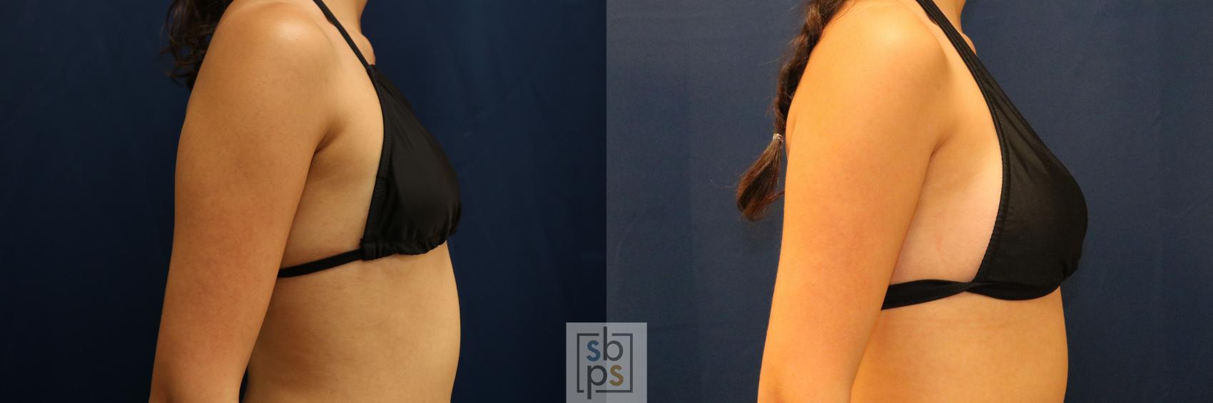 Before & After Breast Augmentation Case 775 Bikini Right View in Los Angeles, Torrance & Long Beach, CA