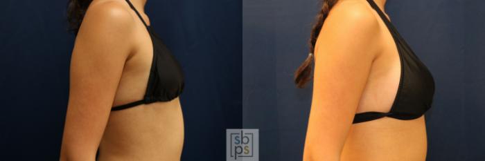 Before & After Breast Augmentation Case 775 Bikini Right View in Los Angeles, Torrance & Long Beach, CA