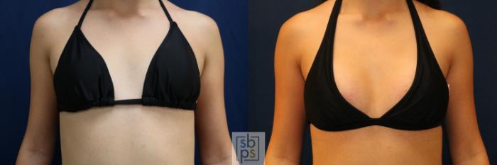 Before & After Breast Augmentation Case 775 Bikini View in Los Angeles, Torrance & Long Beach, CA