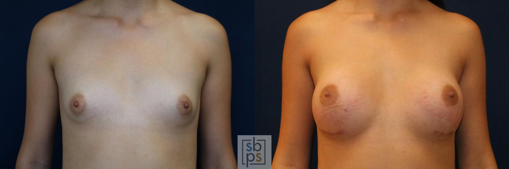 Before & After Breast Augmentation Case 775 Front View in Los Angeles, Torrance & Long Beach, CA