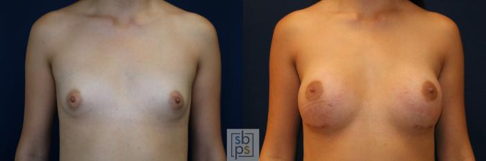 Before & After Breast Augmentation Case 775 Front View in Los Angeles, Torrance & Long Beach, CA