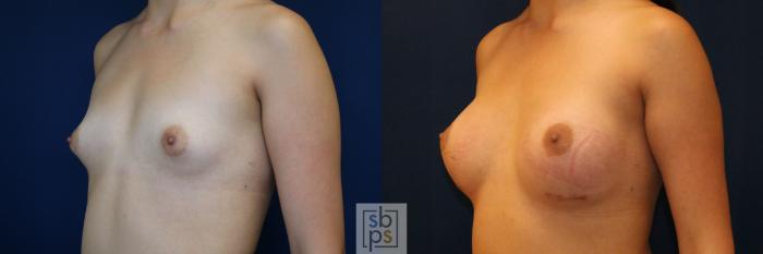 Before & After Breast Augmentation Case 775 Left Oblique View in Los Angeles, Torrance & Long Beach, CA