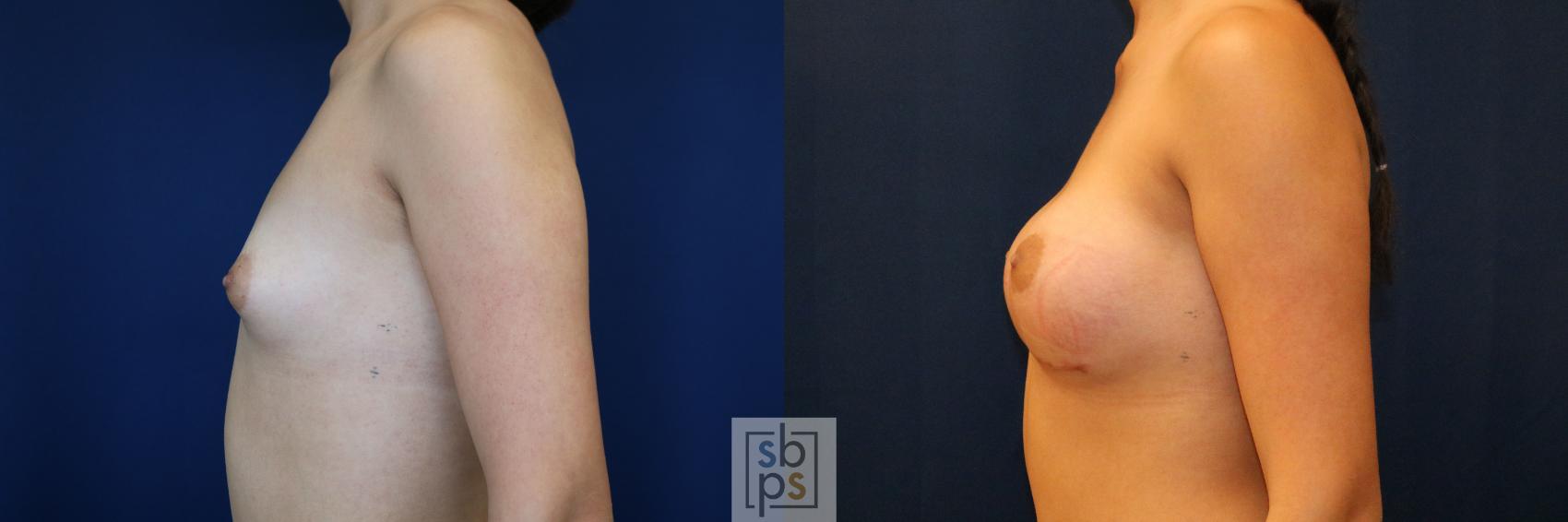 Before & After Breast Augmentation Case 775 Left Side View in Los Angeles, Torrance & Long Beach, CA