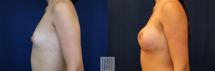 Before & After Breast Augmentation Case 775 Left Side View in Los Angeles, Torrance & Long Beach, CA