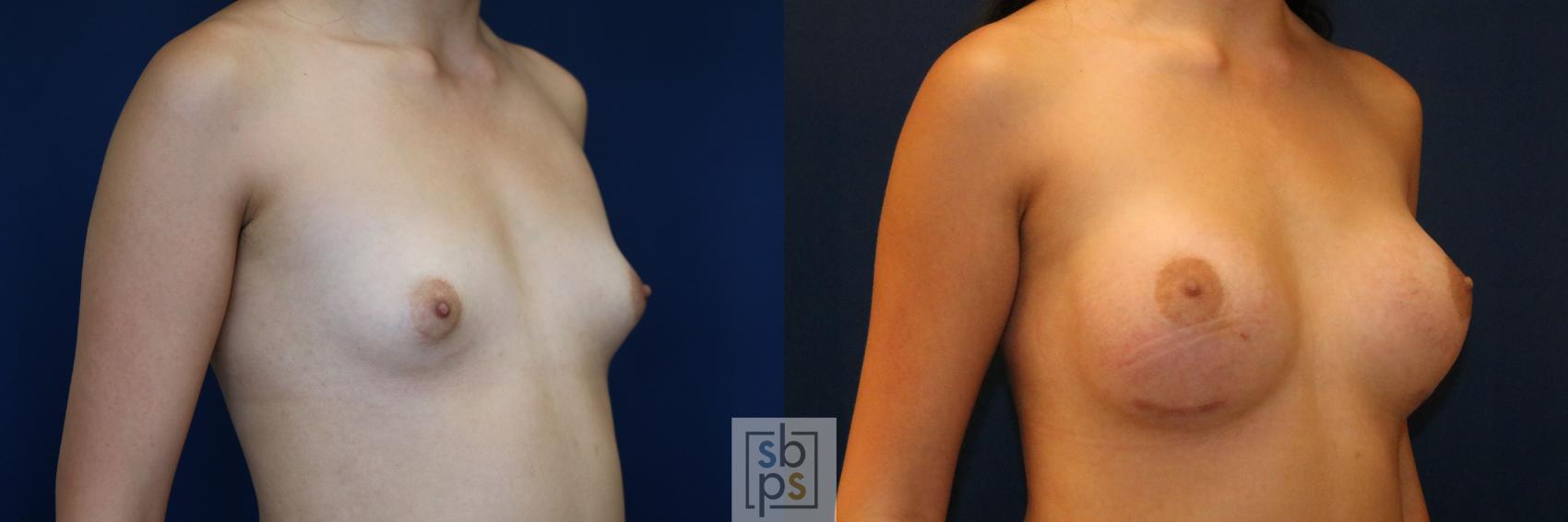 Before & After Breast Augmentation Case 775 Right Oblique View in Los Angeles, Torrance & Long Beach, CA