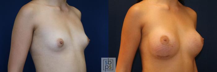 Before & After Breast Augmentation Case 775 Right Oblique View in Los Angeles, Torrance & Long Beach, CA