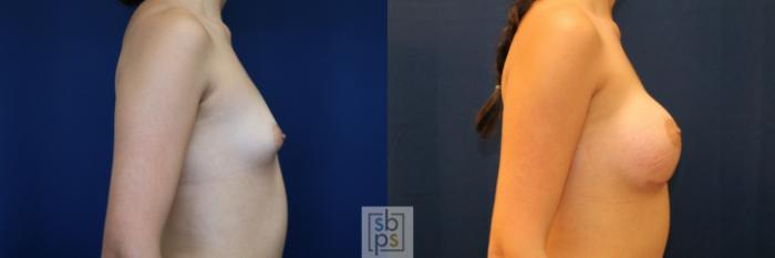 Before & After Breast Augmentation Case 775 Right Side View in Los Angeles, Torrance & Long Beach, CA
