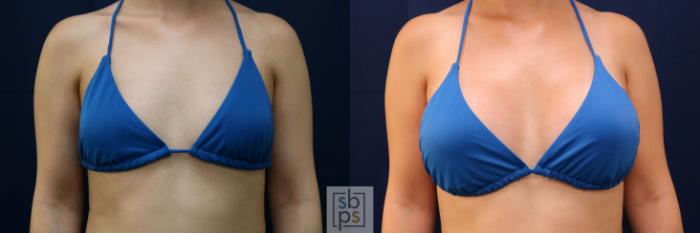 Before & After Breast Augmentation Case 776 Bikini View in Los Angeles, Torrance & Long Beach, CA