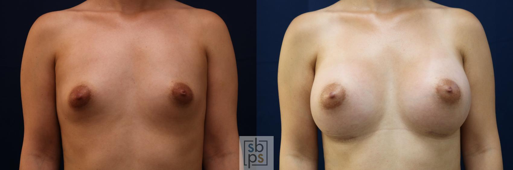 Before & After Breast Augmentation Case 776 Front View in Los Angeles, Torrance & Long Beach, CA