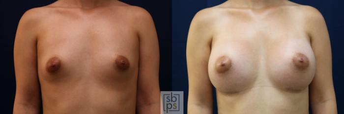 Before & After Breast Augmentation Case 776 Front View in Los Angeles, Torrance & Long Beach, CA