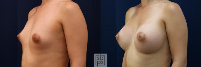 Before & After Breast Augmentation Case 776 Left Oblique View in Los Angeles, Torrance & Long Beach, CA
