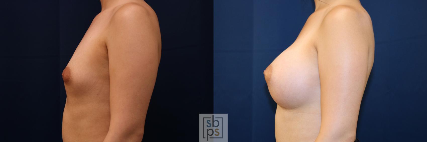 Before & After Breast Augmentation Case 776 Left Side View in Los Angeles, Torrance & Long Beach, CA