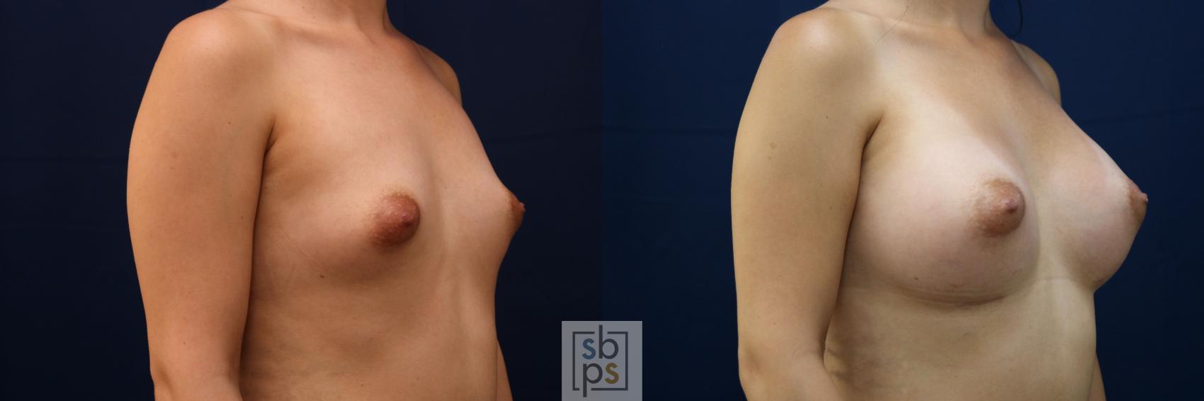Before & After Breast Augmentation Case 776 Right Oblique View in Los Angeles, Torrance & Long Beach, CA
