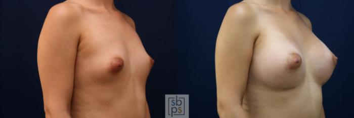 Before & After Breast Augmentation Case 776 Right Oblique View in Los Angeles, Torrance & Long Beach, CA