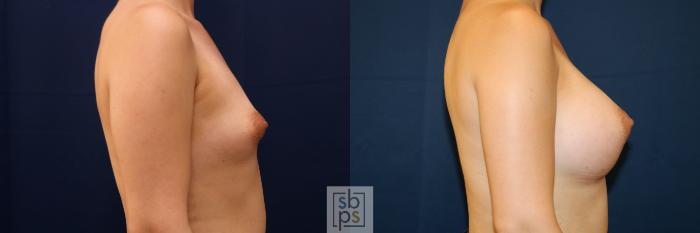 Before & After Breast Augmentation Case 776 Right Side View in Los Angeles, Torrance & Long Beach, CA
