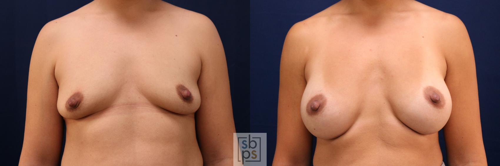 Before & After Breast Augmentation Case 777 Front View in Los Angeles, Torrance & Long Beach, CA