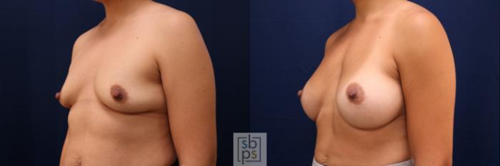 Before & After Breast Augmentation Case 777 Left Oblique View in Los Angeles, Torrance & Long Beach, CA