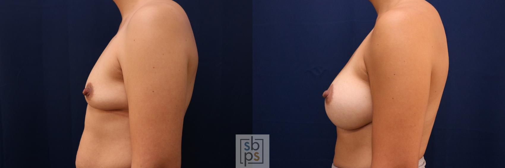 Before & After Breast Augmentation Case 777 Left Side View in Los Angeles, Torrance & Long Beach, CA