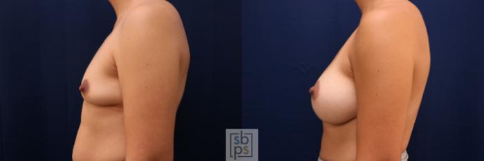 Before & After Breast Augmentation Case 777 Left Side View in Los Angeles, Torrance & Long Beach, CA