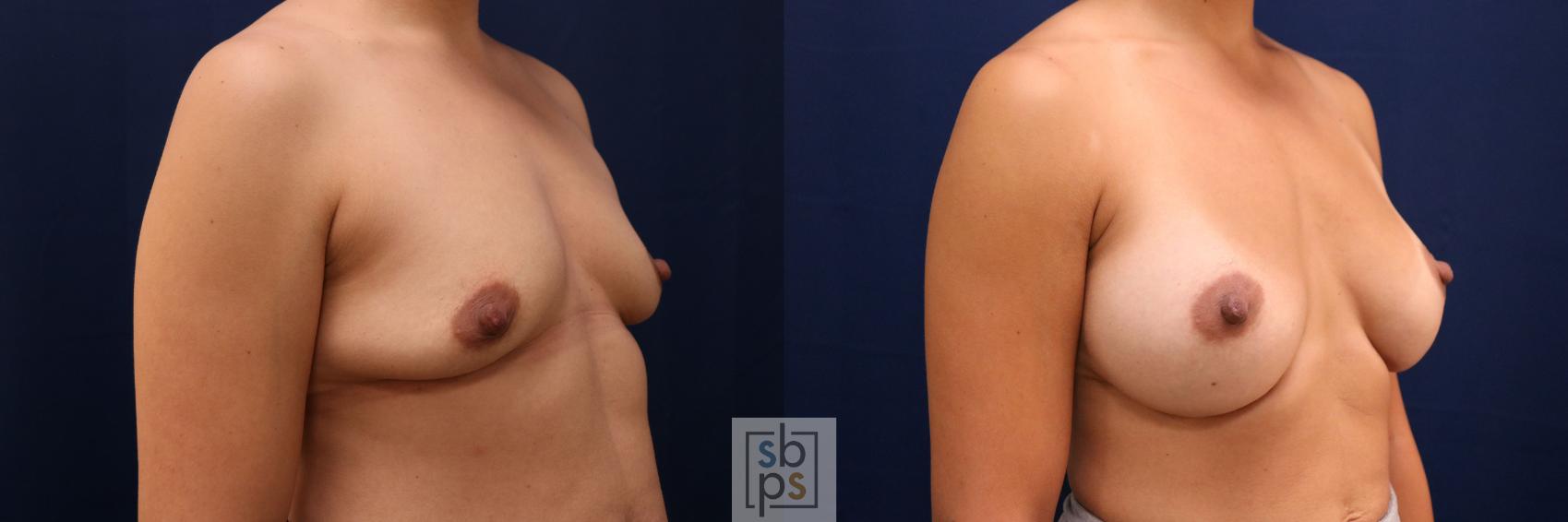 Before & After Breast Augmentation Case 777 Right Oblique View in Los Angeles, Torrance & Long Beach, CA