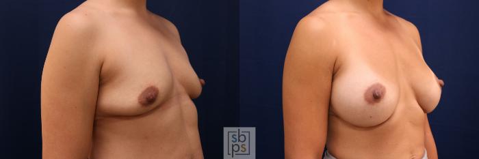 Before & After Breast Augmentation Case 777 Right Oblique View in Los Angeles, Torrance & Long Beach, CA