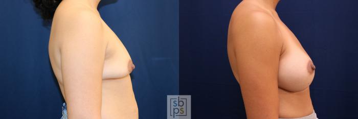 Before & After Breast Augmentation Case 777 Right Side View in Los Angeles, Torrance & Long Beach, CA