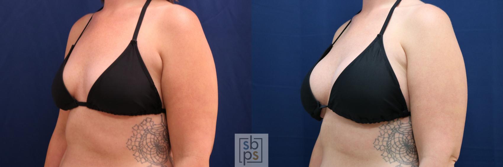 Before & After Breast Augmentation Case 778 Bikini Left Oblique View in Los Angeles, Torrance & Long Beach, CA