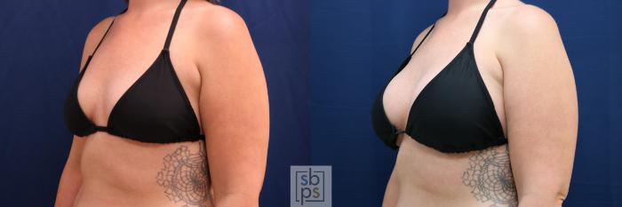 Before & After Breast Augmentation Case 778 Bikini Left Oblique View in Los Angeles, Torrance & Long Beach, CA
