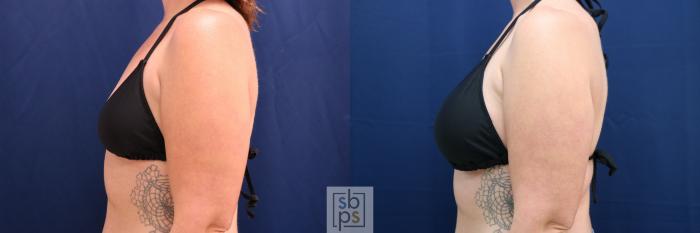 Before & After Breast Augmentation Case 778 Bikini Left View in Los Angeles, Torrance & Long Beach, CA