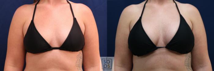 Before & After Breast Augmentation Case 778 Bikini View in Los Angeles, Torrance & Long Beach, CA