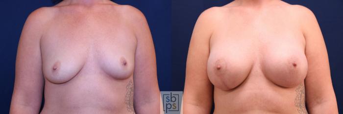 Before & After Breast Augmentation Case 778 Front View in Los Angeles, Torrance & Long Beach, CA