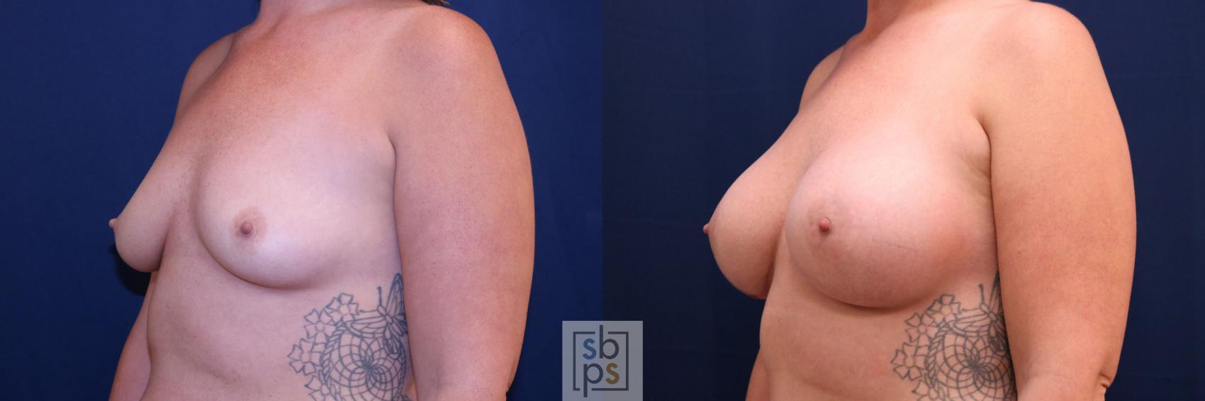 Before & After Breast Augmentation Case 778 Left Oblique View in Los Angeles, Torrance & Long Beach, CA