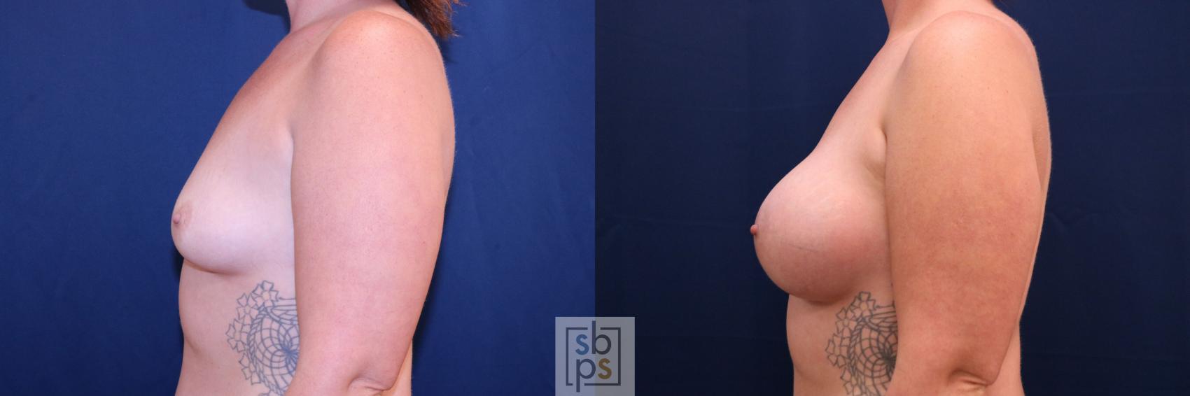 Before & After Breast Augmentation Case 778 Left Side View in Los Angeles, Torrance & Long Beach, CA